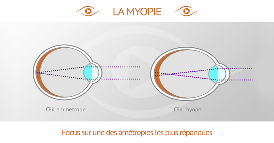 ameliorarea de la miopie