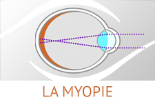 Focus sur la myopie une ametropie très repandue