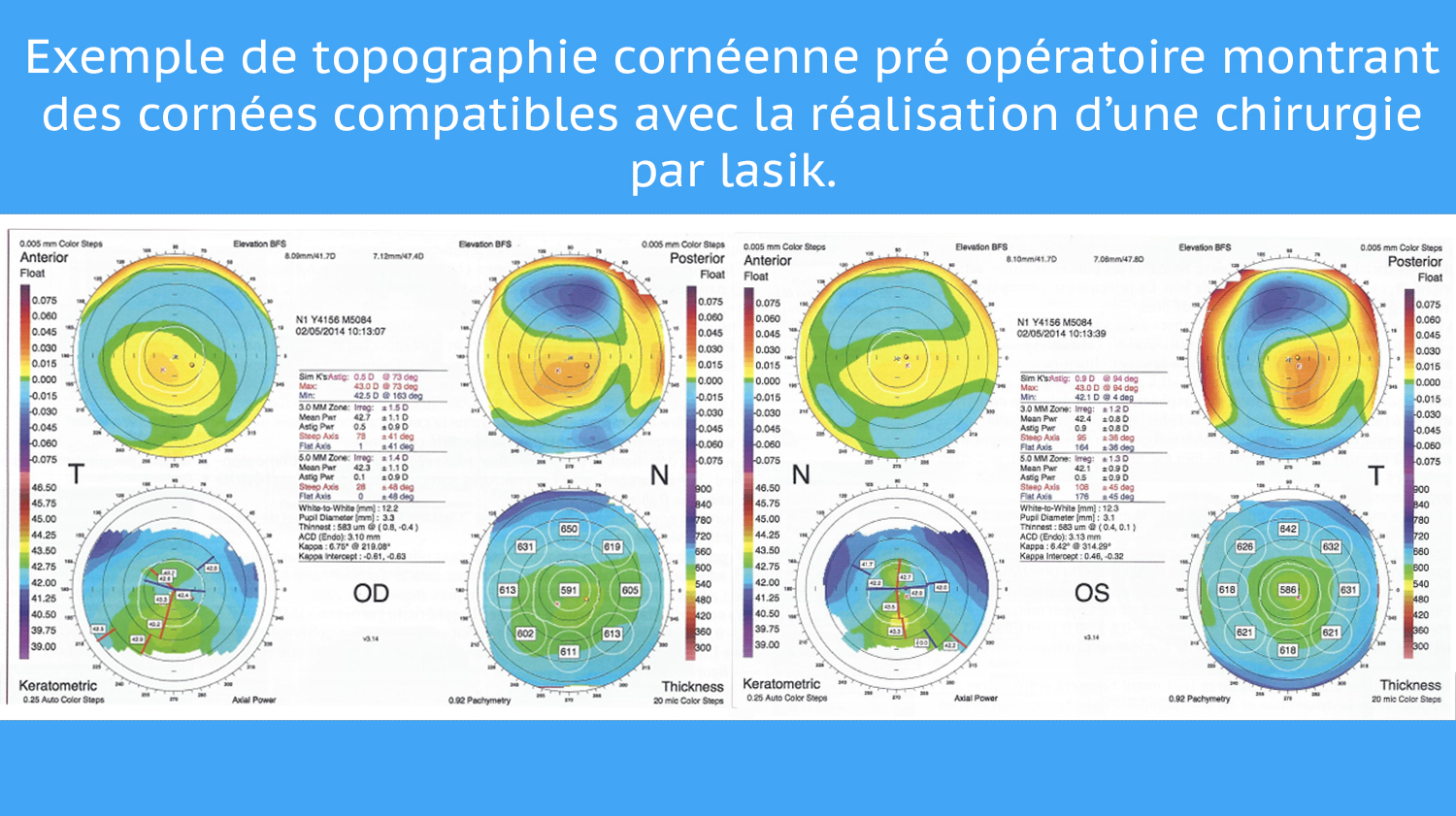 topographie cornéenne préopératoire montrant des cornées apte à subir de la chirurgie refractive.