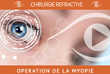 La chirurgie refractive avec la myopie en 2022