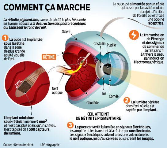 topographie cornéenne préopératoire montrant des cornées apte à subir de la chirurgie refractive.