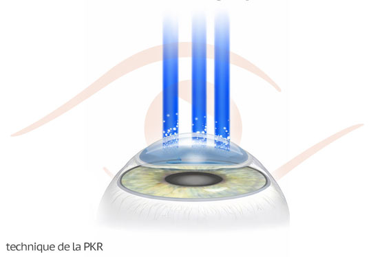 PKR : traitement de surface au laser Excimer
