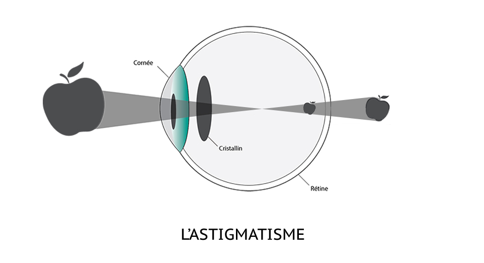 Schéma explicatif du fonctionnement de l'oeil astigmate.