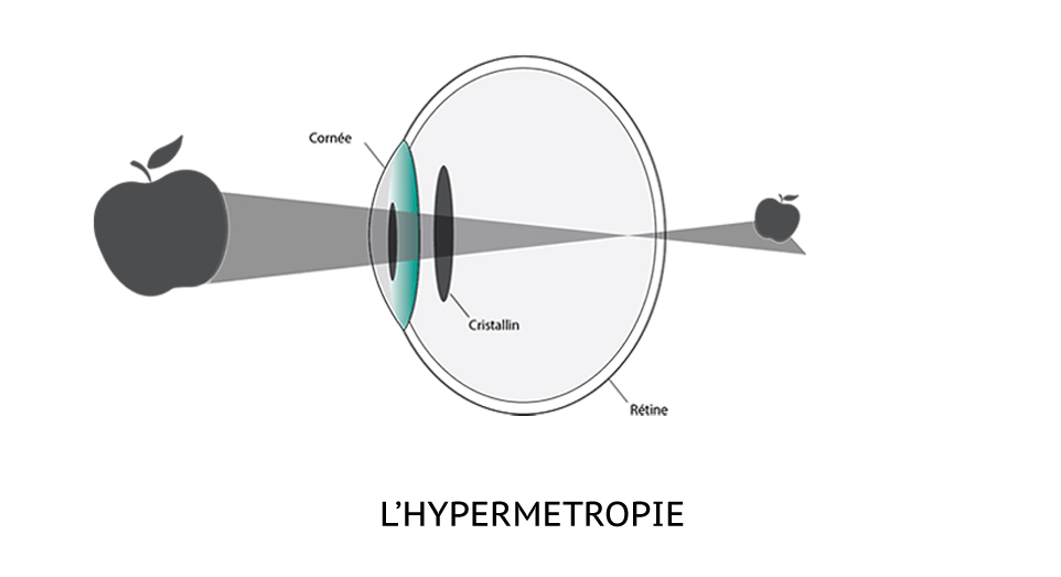 Schéma explicatif du fonctionnement de l'oeil hypermetrope.