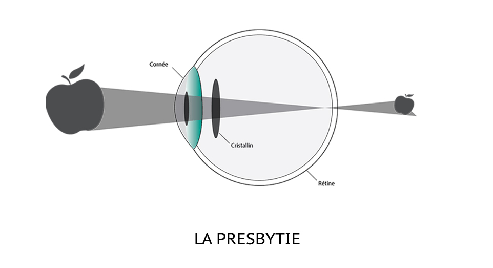 schémat explicatif de l'oeil presbyte